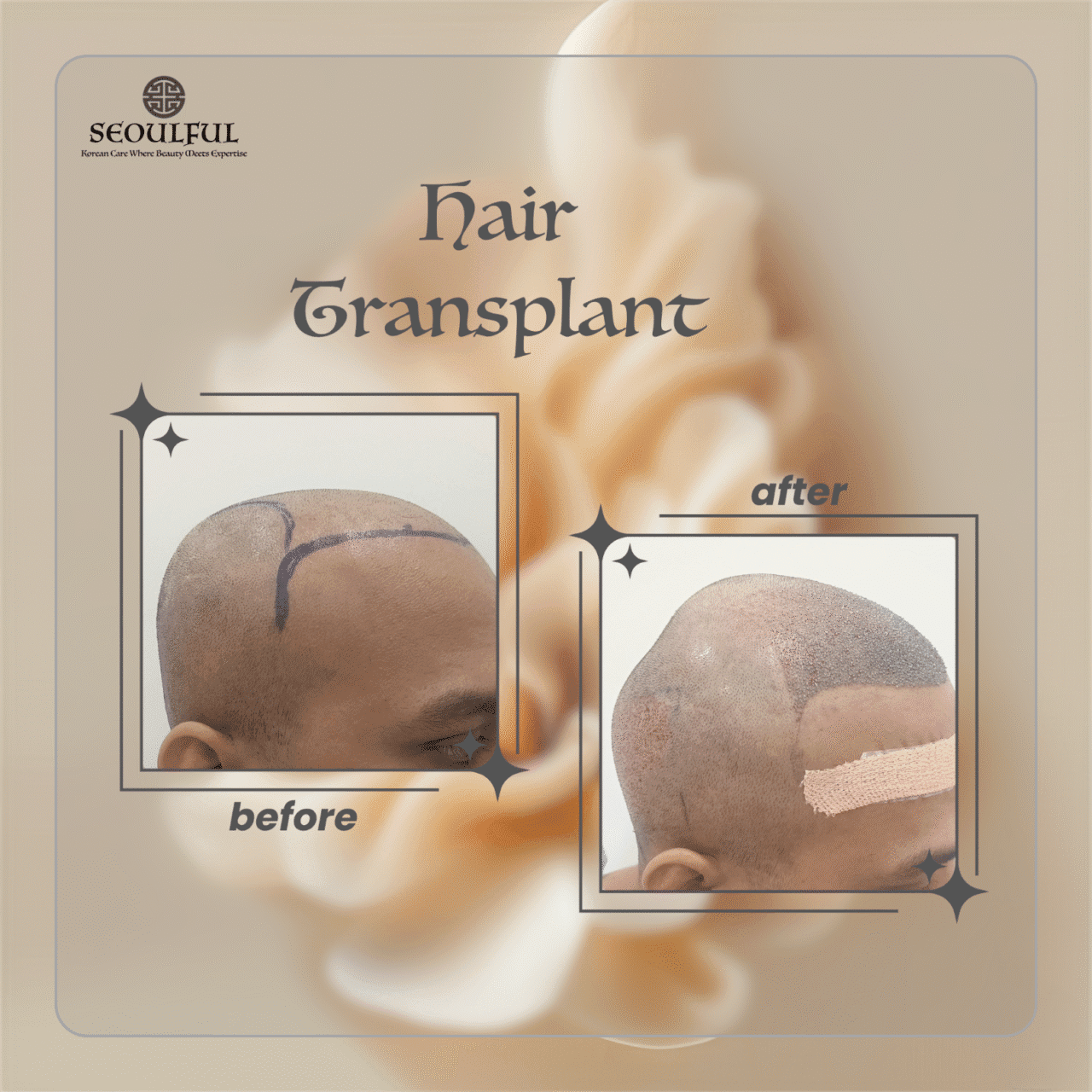 Hair Transplant