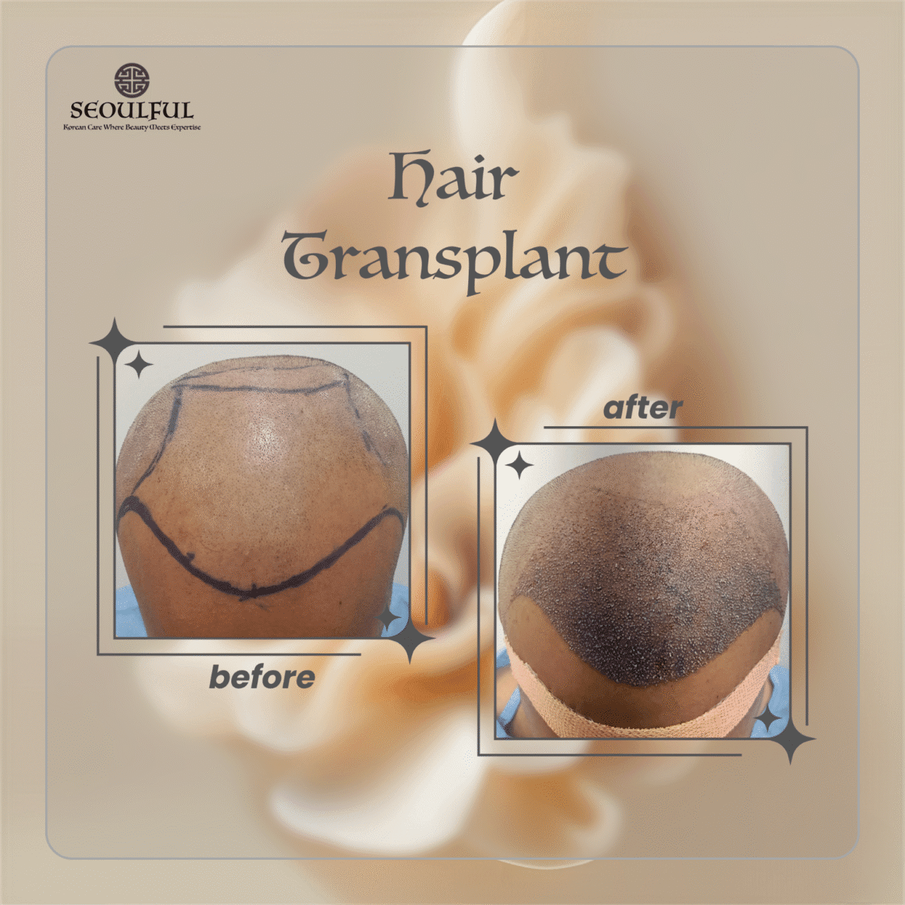 Hair Transplant
