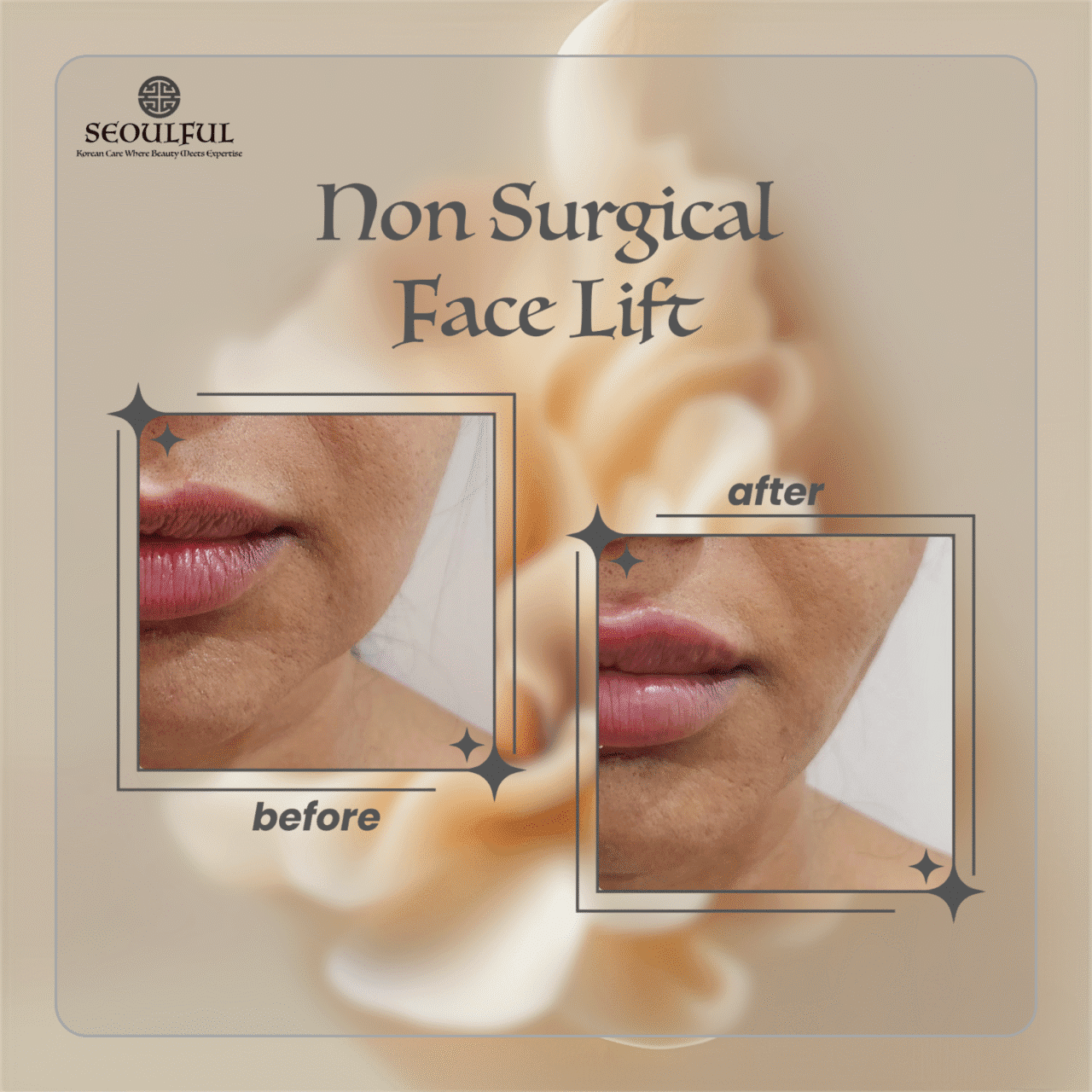 Non Surgical Facelift